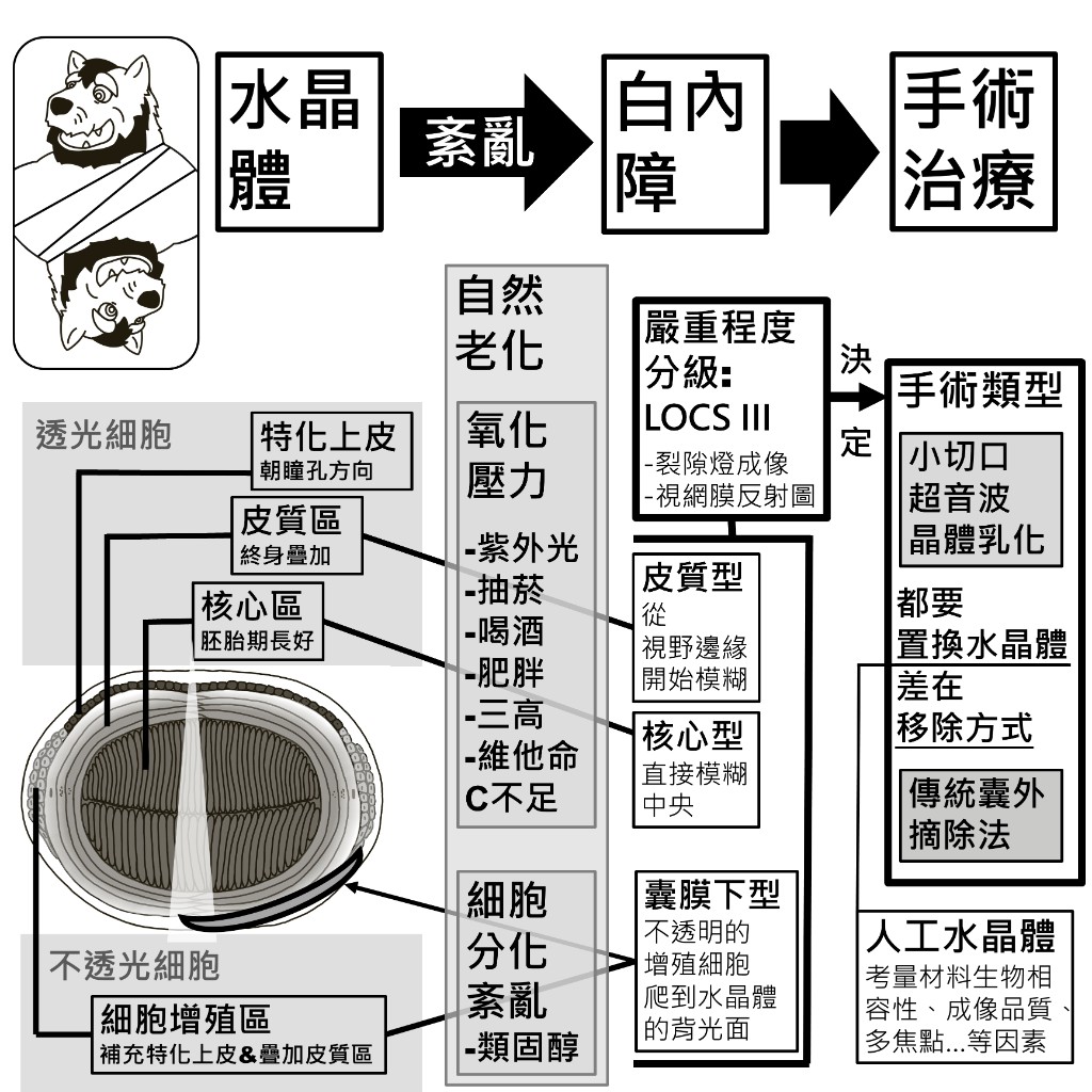 白內障成因：氧化壓力與細胞分化紊亂，分別對應皮質型、核心型與囊膜下型白內障，再由 LOCS III 分級決定手術類型