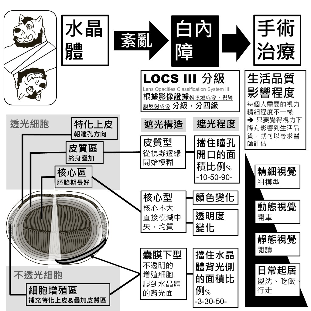 LOCS III 分級依據、三種型別的遮光構造與遮光程度衡量方式，以及生活品質影響程度；視力影響生活時可尋求醫師評估
